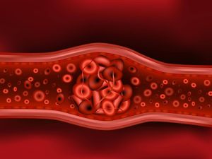 Firecrest Law | Medical Negligence In Preventing Blood Clots In Women Firecrest Law | Medical Negligence In Preventing Blood Clots In Women