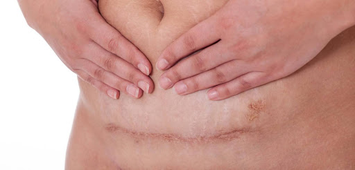 Firecrest Law | Gyn Surgery Infections: What Happens When An Infection Goes Undiagnosed